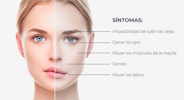 Infografía: Parálisis facial